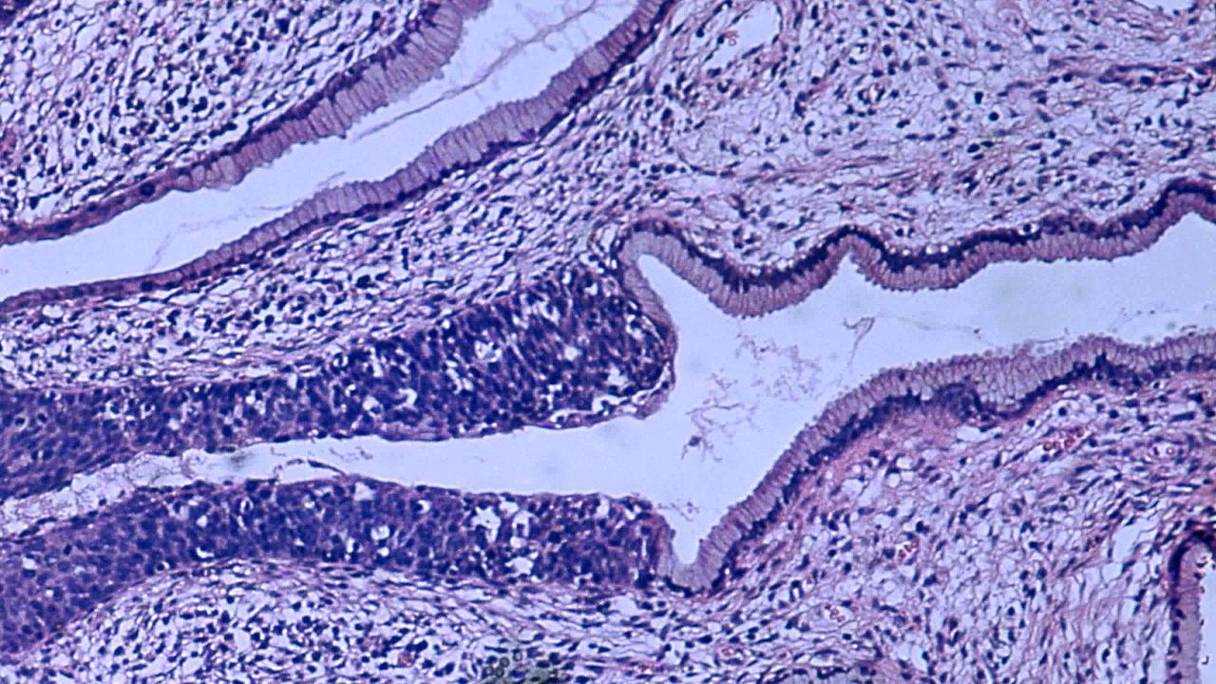 Dysplasie de haut grade (carcinome in situ) du col de l'utérus, photographié au microscope. Cette maladie peut évoluer vers un cancer invasif (carcinome épidermoïde) du col de l'utérus.
